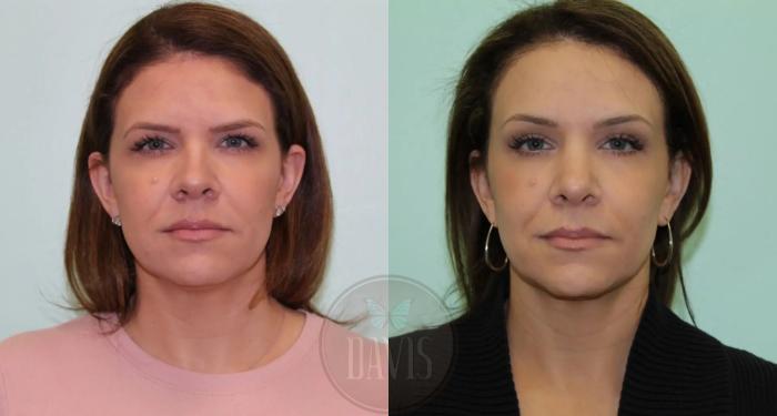 Before & After Browlift Case 1000 View 1 View in Tampa, FL