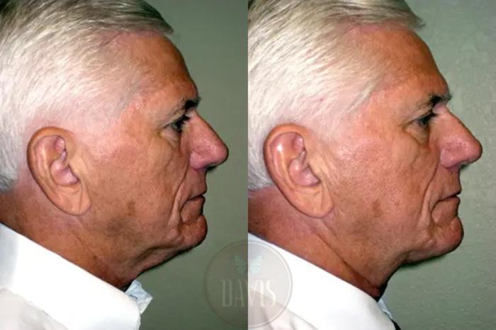 Before & After Neck Lift Case 1035 View 1 View in Tampa, FL