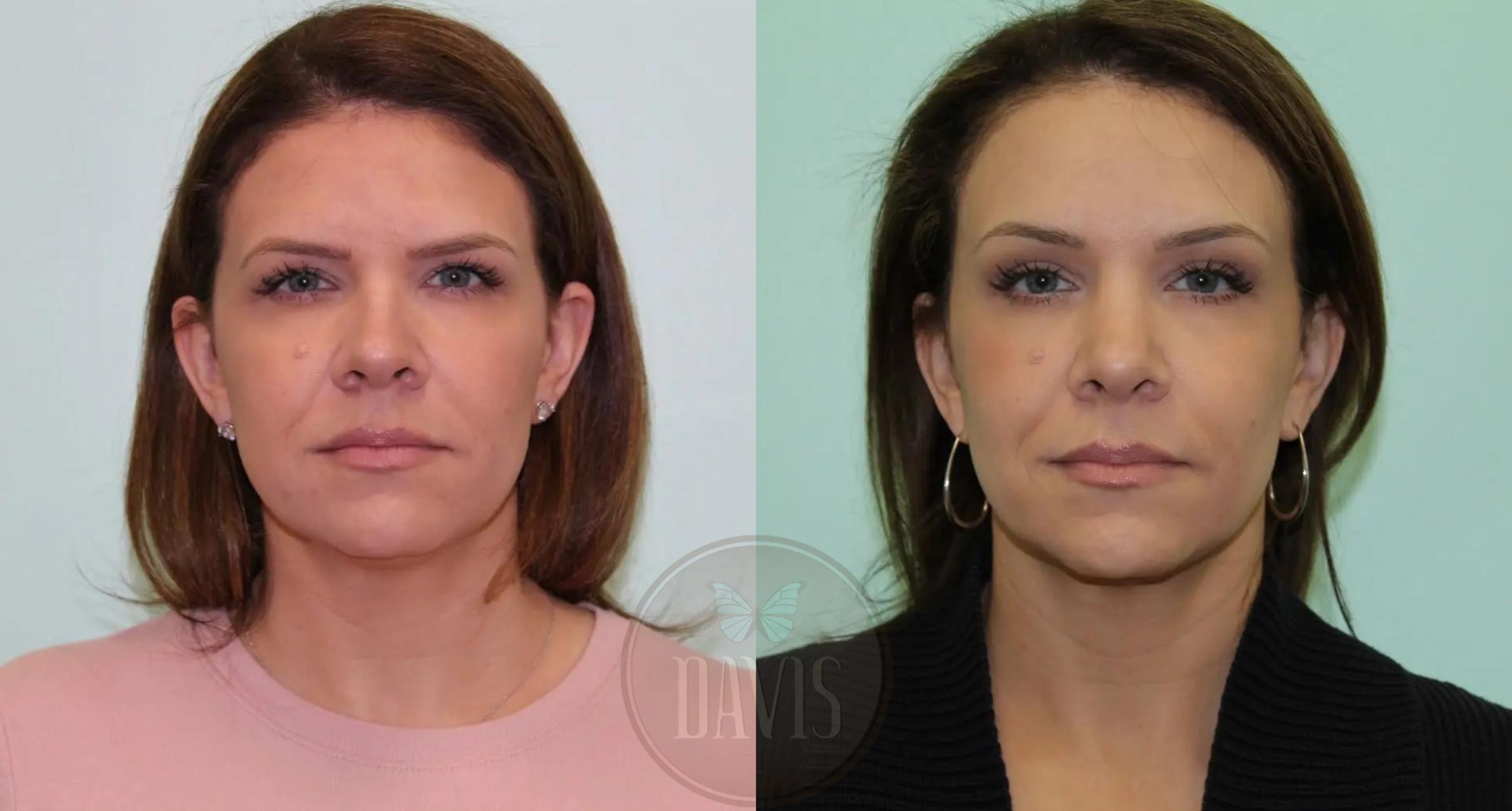 Before & After Browlift Case 1000 View 1 View in Tampa, FL