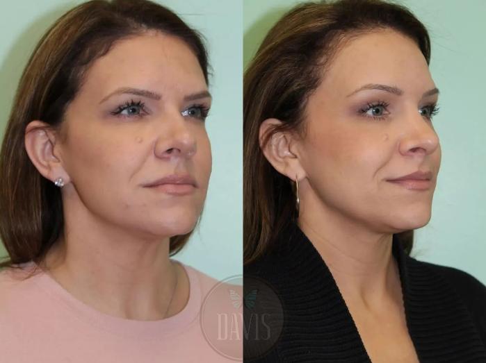 Before & After Browlift Case 1000 View 2 View in Tampa, FL