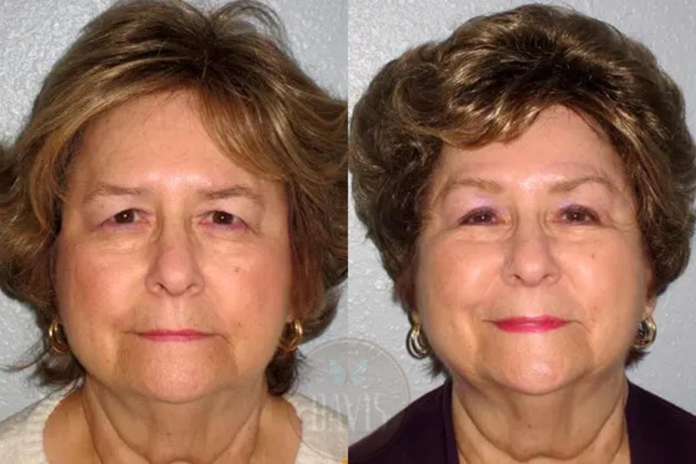 Before & After Browlift Case 1001 View 1 View in Tampa, FL