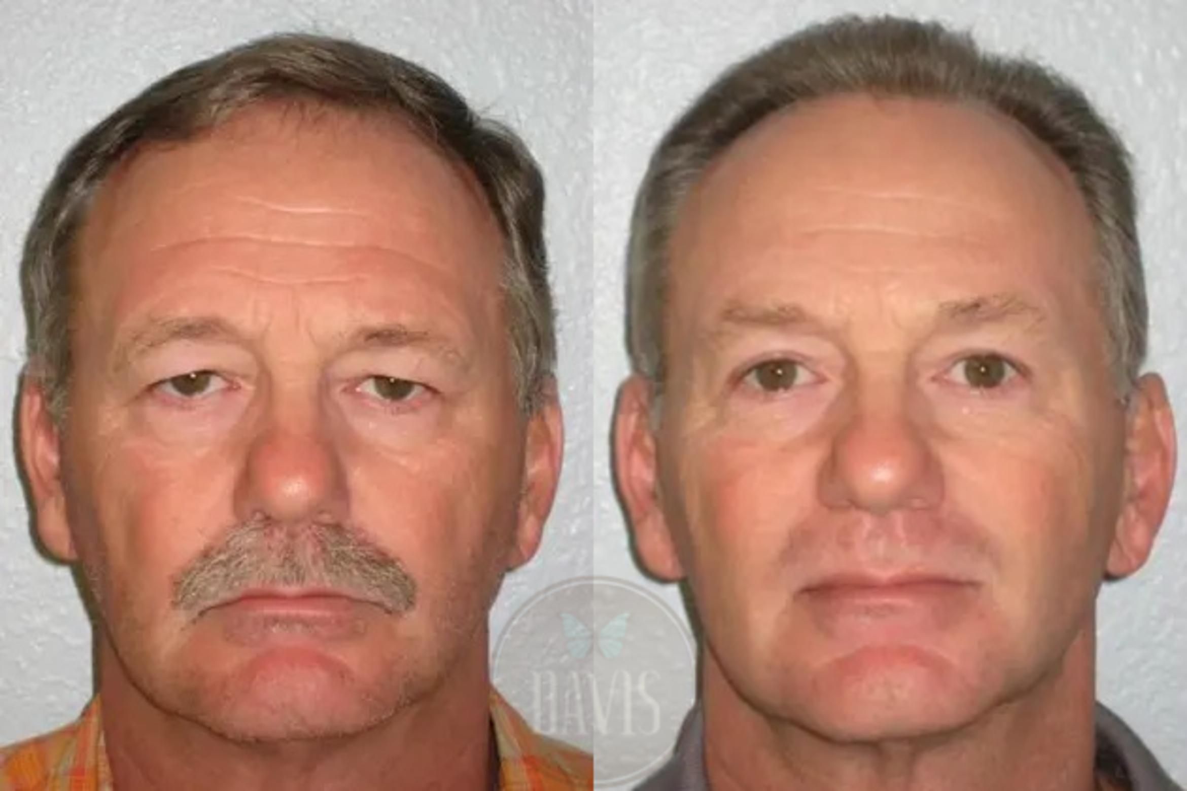 Before & After Browlift Case 1002 View 1 View in Tampa, FL