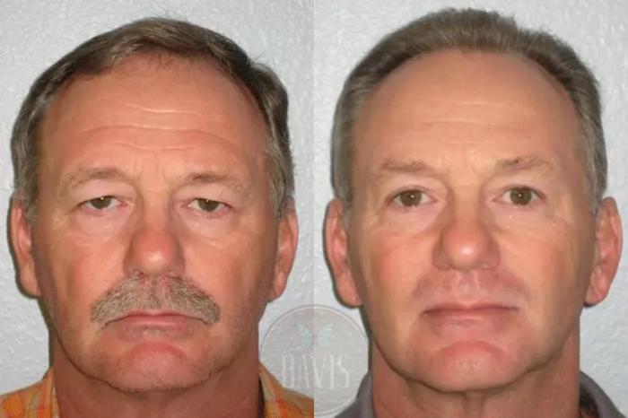 Before & After Browlift Case 1002 View 1 View in Tampa, FL
