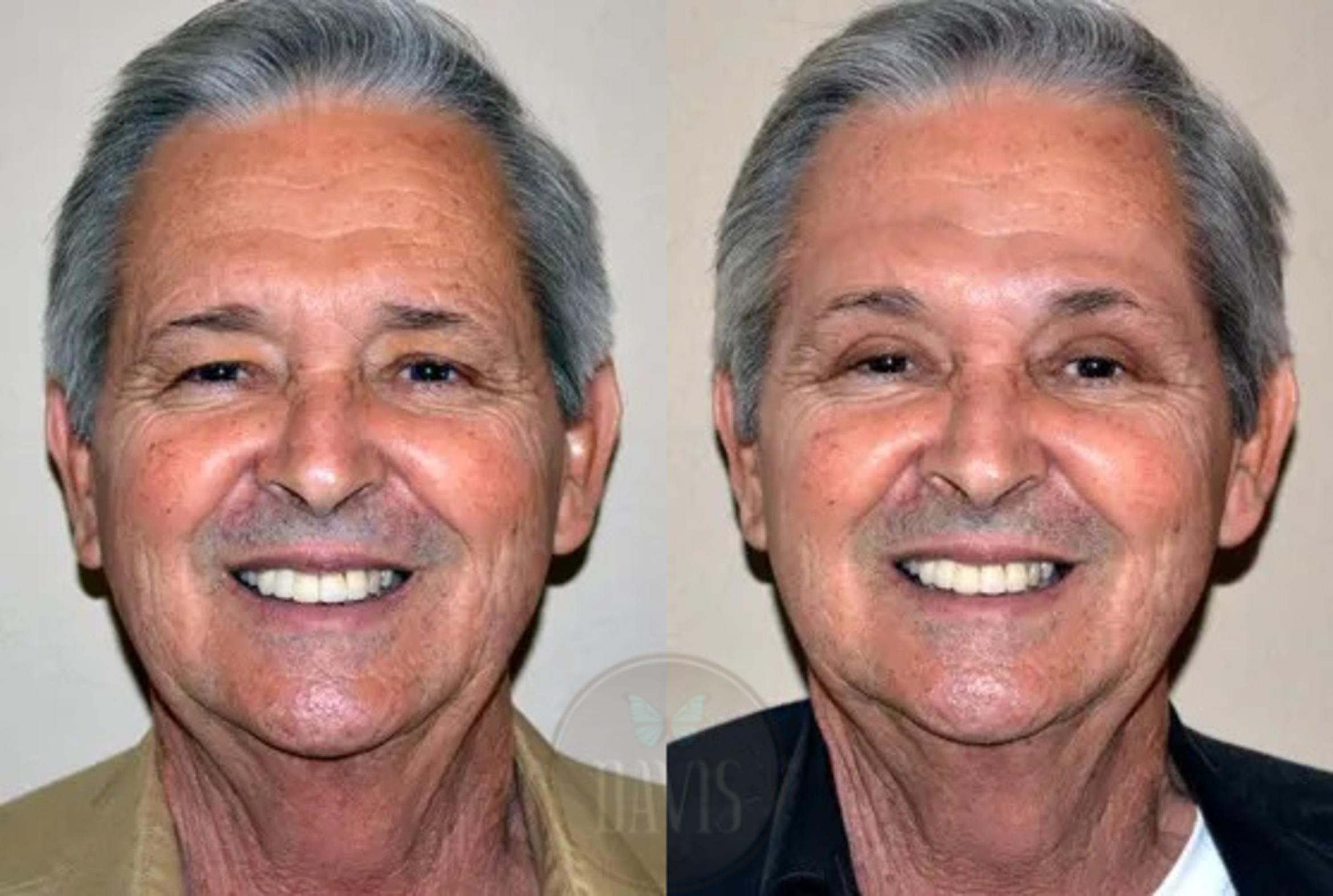 Before & After Browlift Case 1003 View 1 View in Tampa, FL