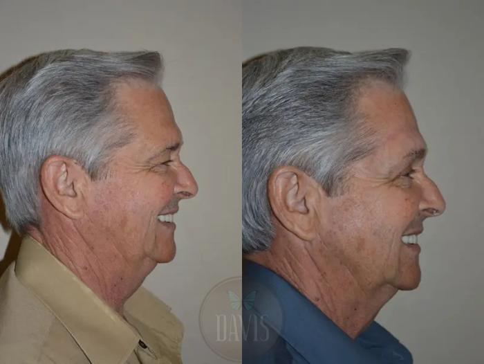Before & After Browlift Case 1003 View 2 View in Tampa, FL