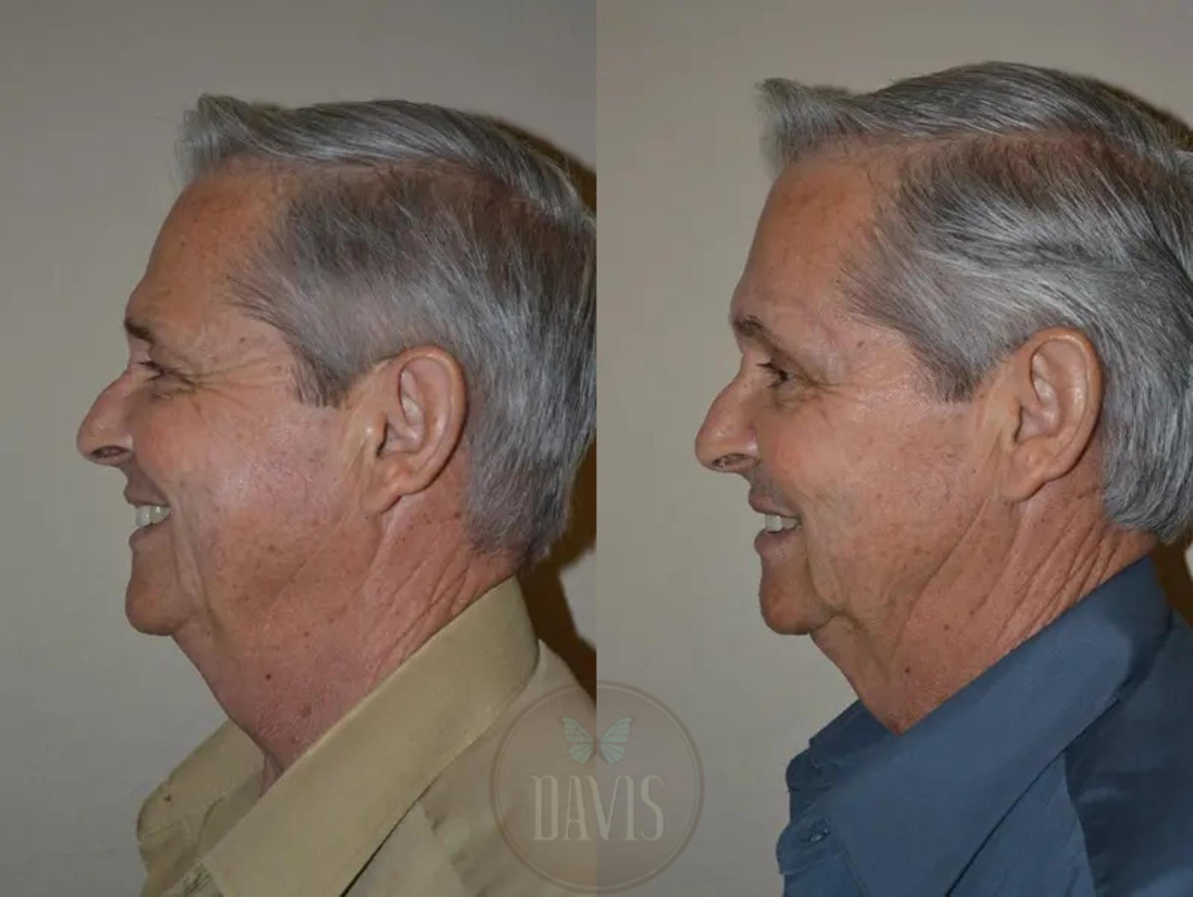 Before & After Browlift Case 1003 View 3 View in Tampa, FL