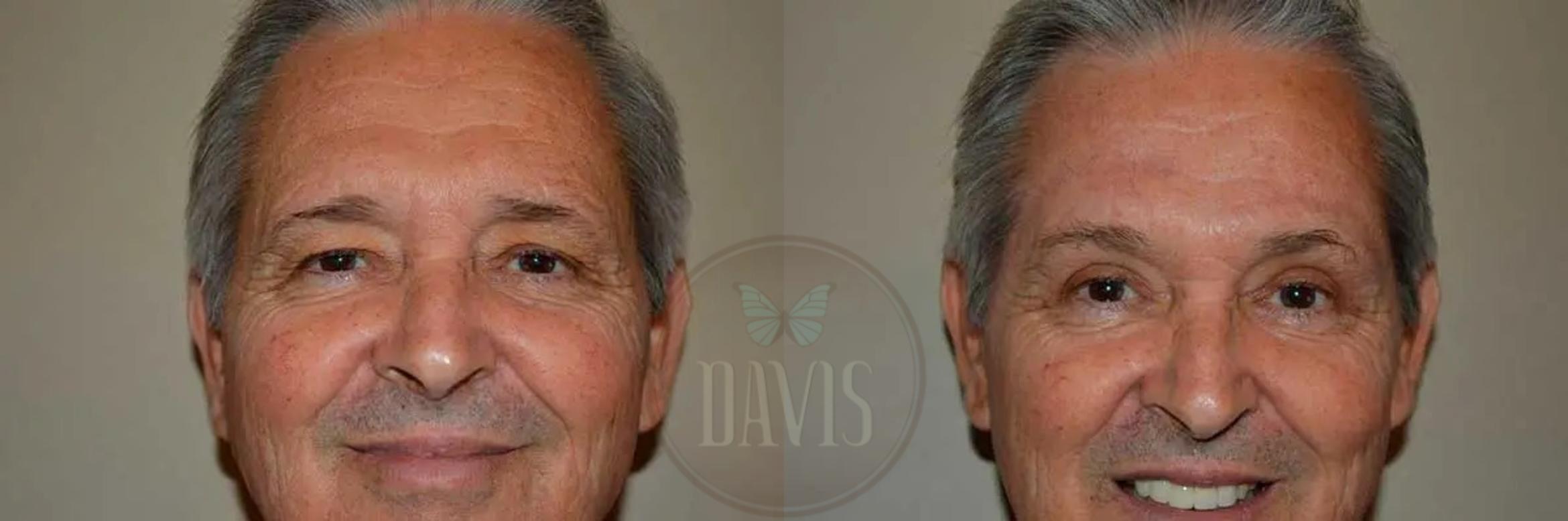 Before & After Browlift Case 1003 View 4 View in Tampa, FL