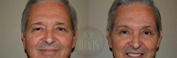 Before & After Browlift Case 1003 View 4 View in Tampa, FL