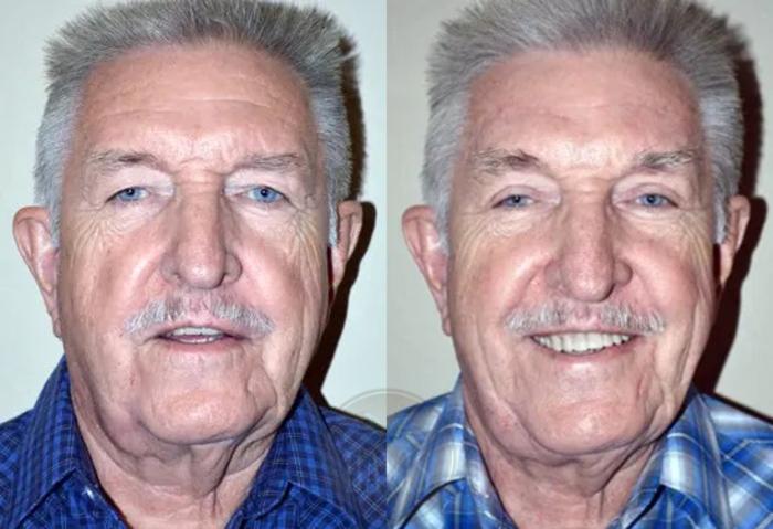 Before & After Browlift Case 1004 View 1 View in Tampa, FL