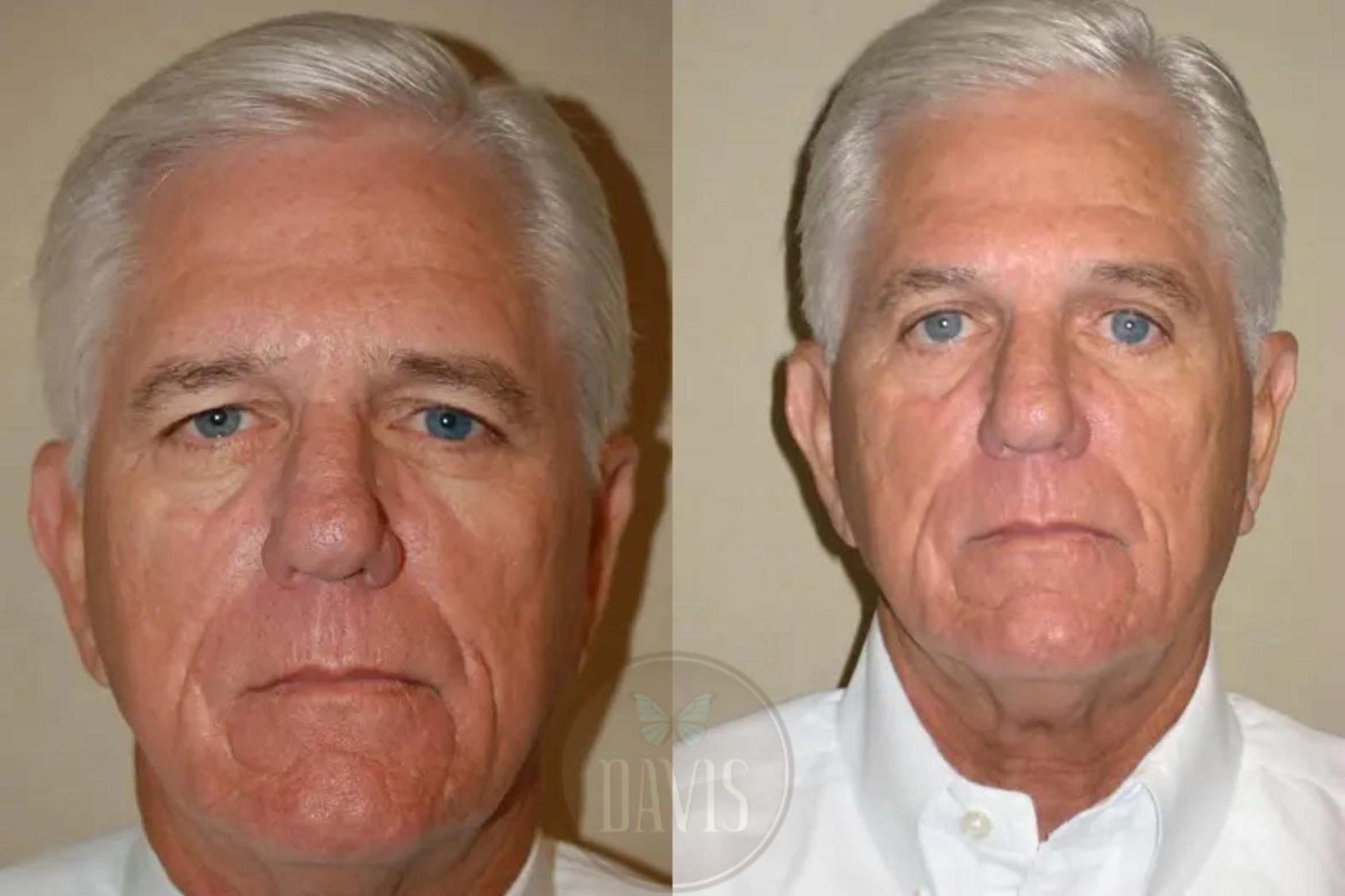 Before & After Browlift Case 1005 View 1 View in Tampa, FL