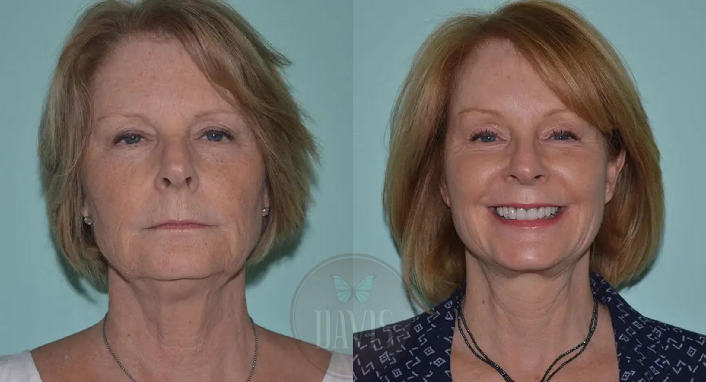 Before & After Browlift Case 1006 View 1 View in Tampa, FL