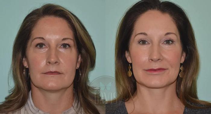 Before & After Browlift Case 1007 View 1 View in Tampa, FL
