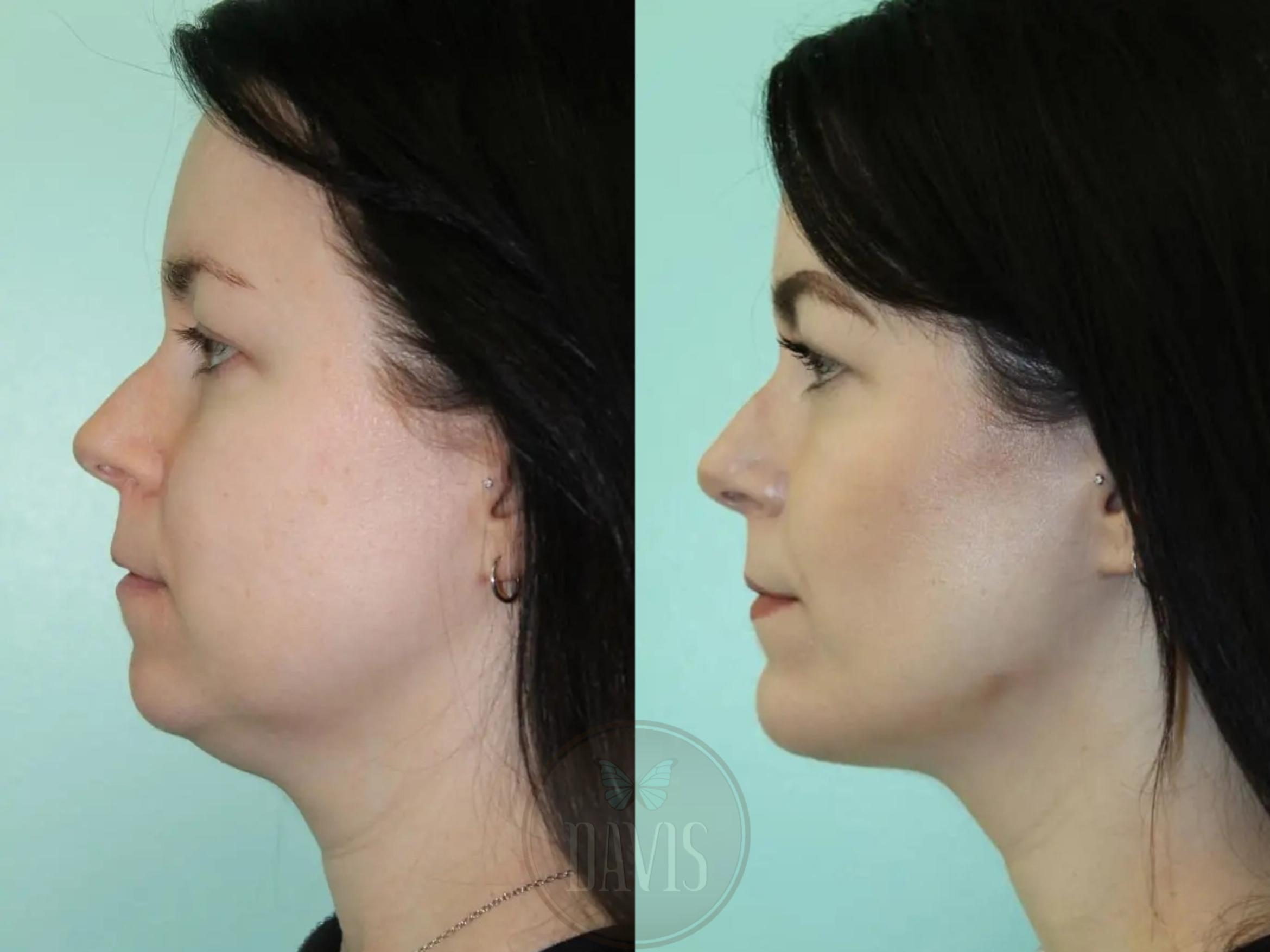 Before & After Buccal Fat Removal Case 1153 View 1 View in Tampa, FL