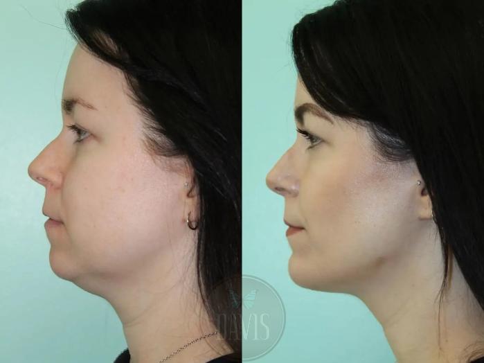 Before & After Buccal Fat Removal Case 1153 View 1 View in Tampa, FL