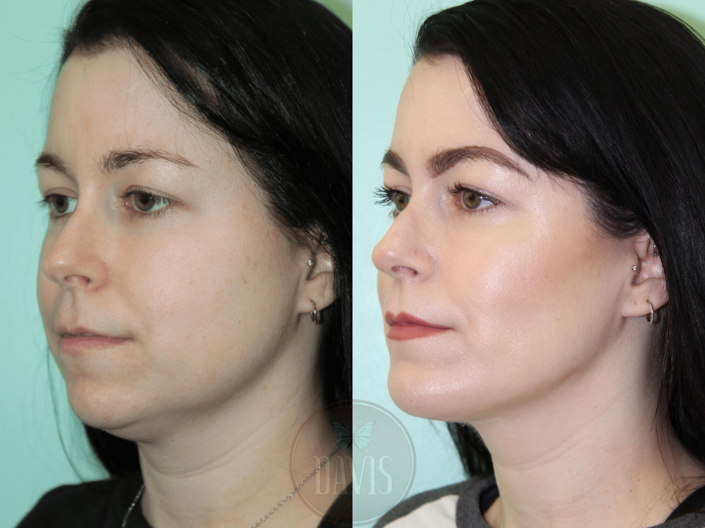 Before & After Buccal Fat Removal Case 1153 View 2 View in Tampa, FL