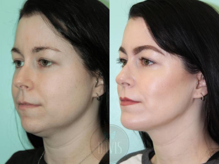 Before & After Buccal Fat Removal Case 1153 View 2 View in Tampa, FL