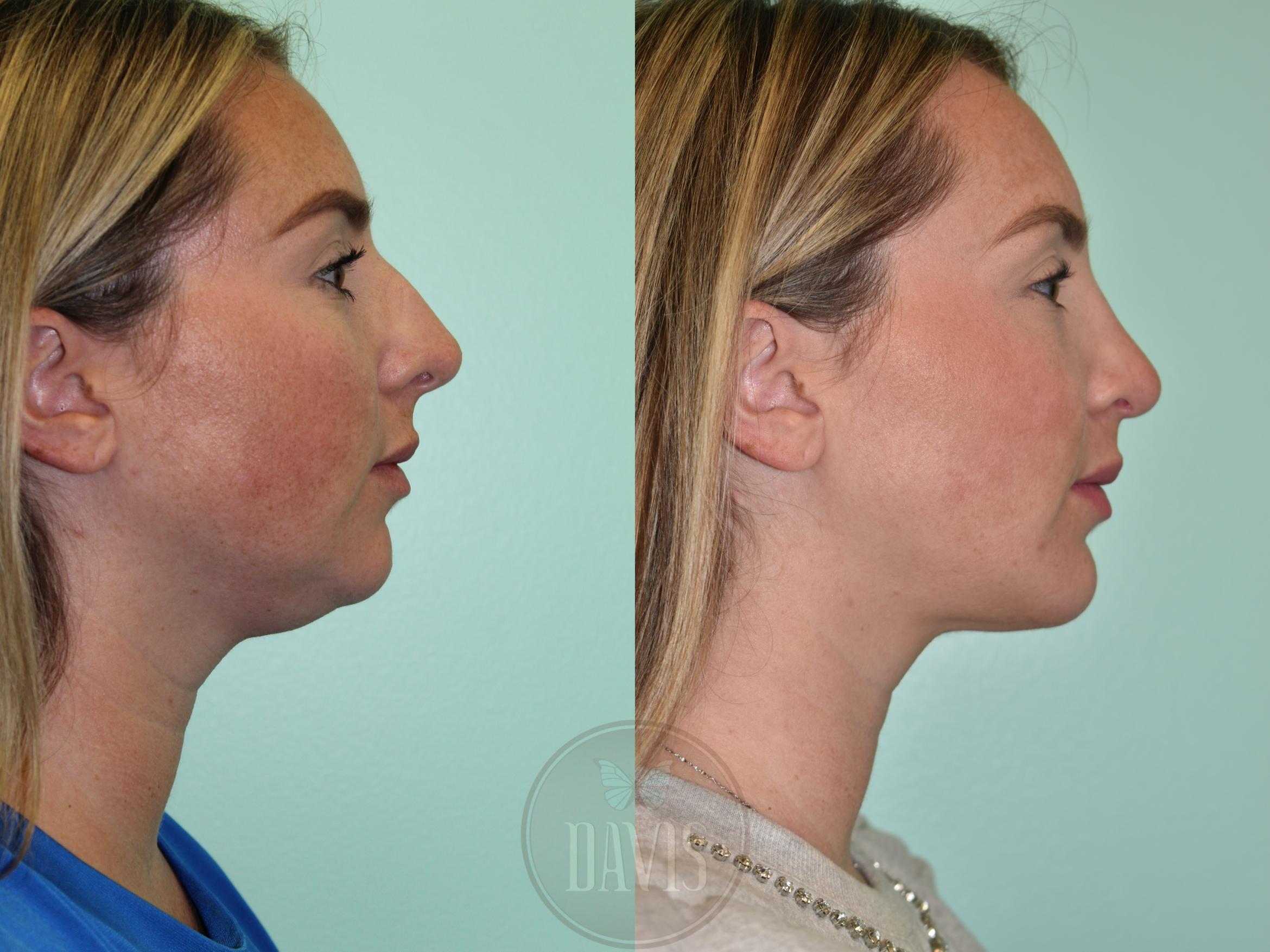 Before & After Buccal Fat Removal Case 1166 Front View in Tampa, FL
