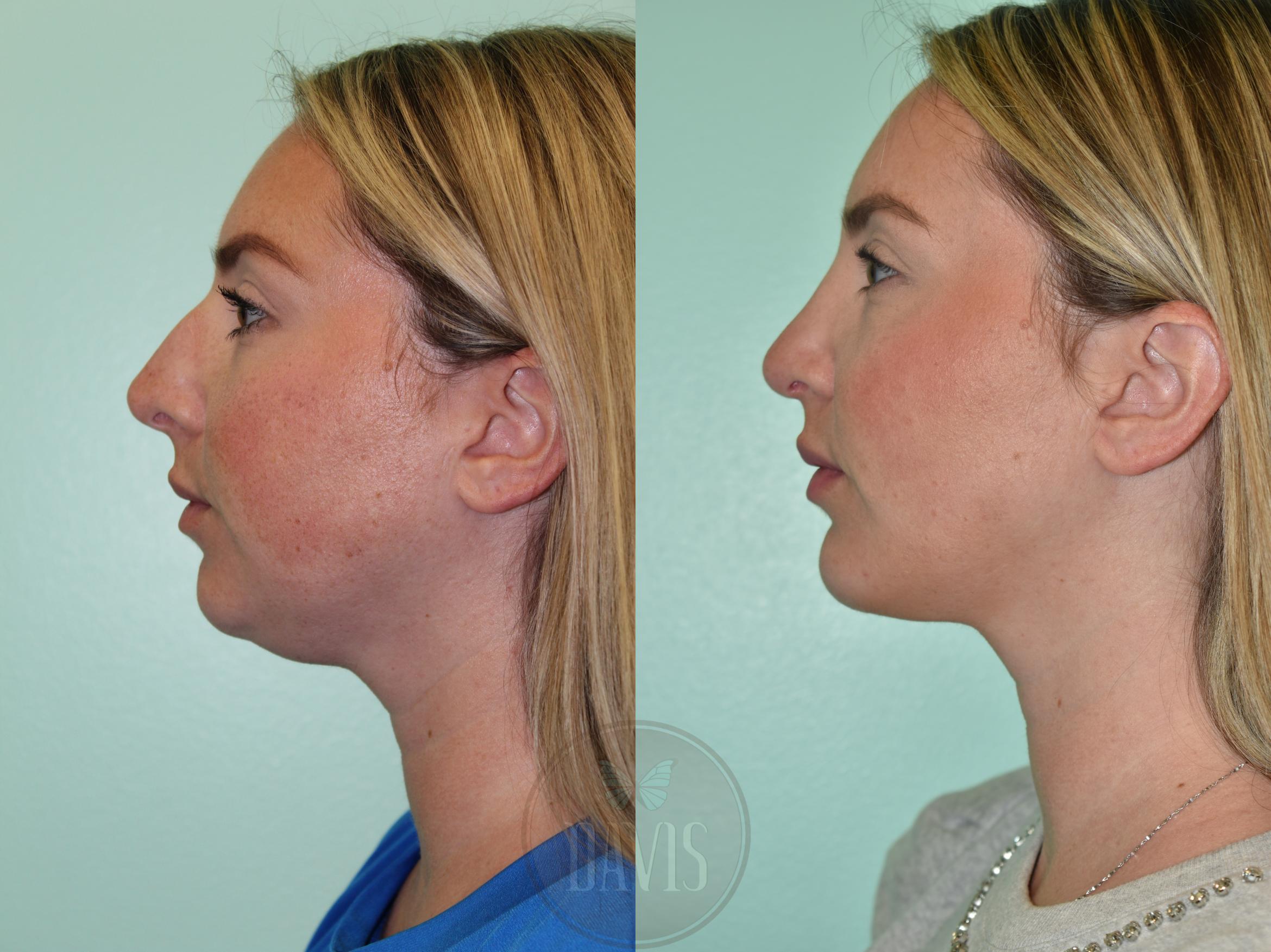Before & After Buccal Fat Removal Case 1166 Left Oblique View in Tampa, FL