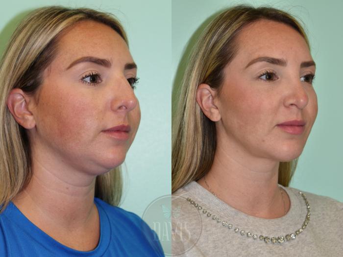 Before & After Buccal Fat Removal Case 1166 Left Side View in Tampa, FL