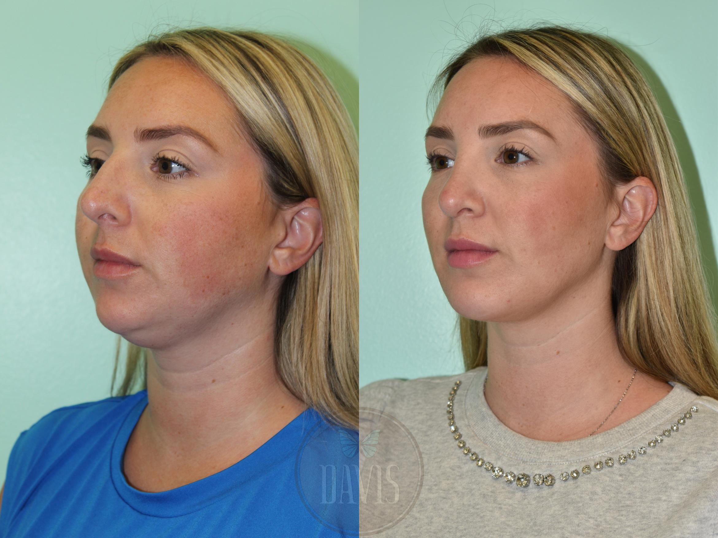Before & After Buccal Fat Removal Case 1166 Right Side View in Tampa, FL