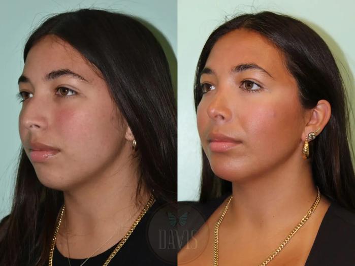 Before & After Chin Augmentation Case 1139 View 1 View in Tampa, FL