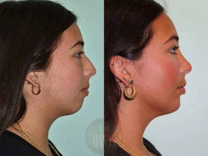 Before & After Chin Augmentation Case 1139 View 2 View in Tampa, FL