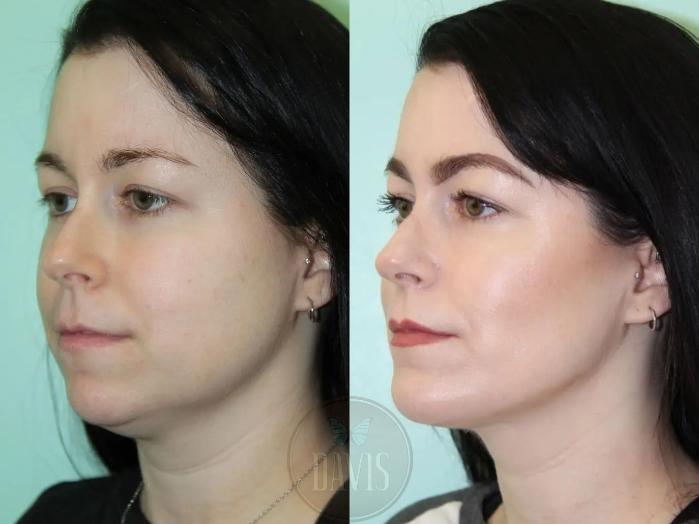 Before & After Chin Augmentation Case 1140 View 1 View in Tampa, FL
