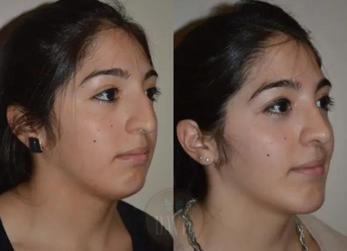 Before & After Chin Augmentation Case 1141 View 1 View in Tampa, FL