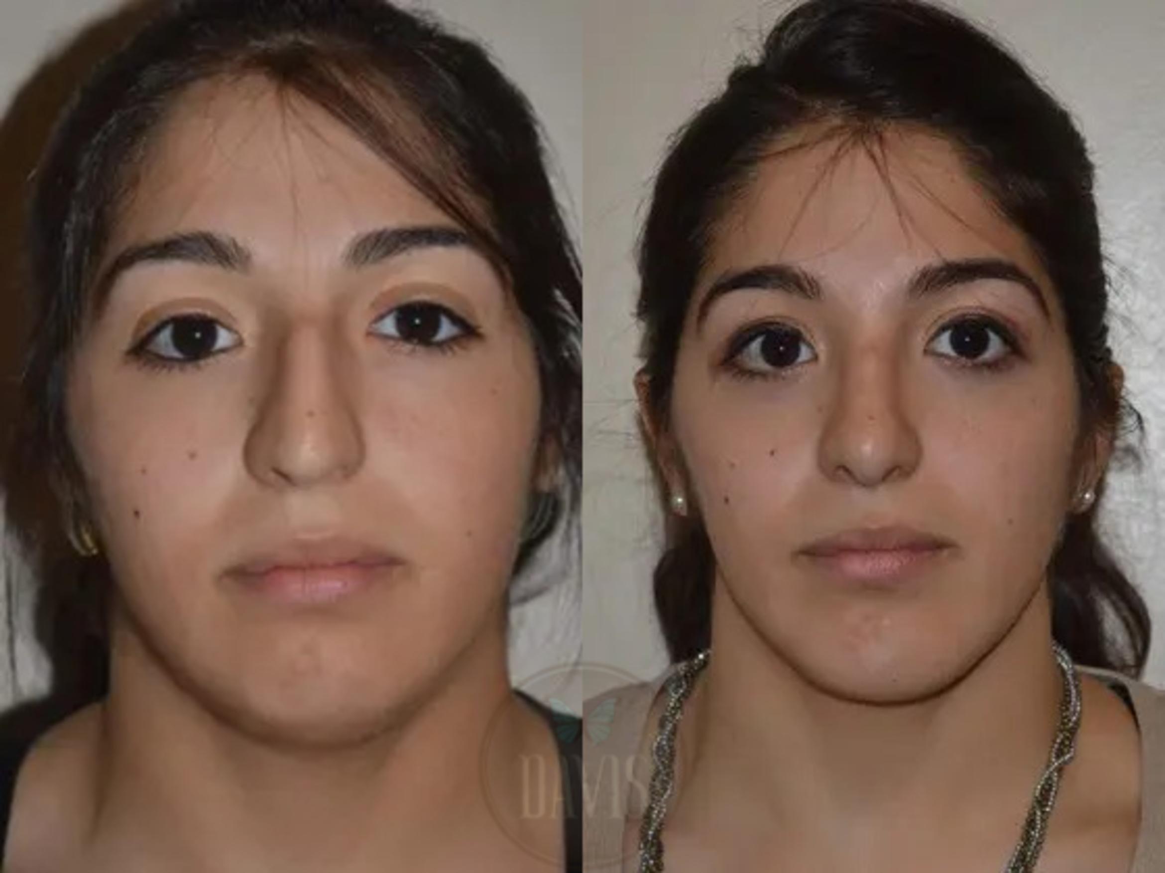 Before & After Chin Augmentation Case 1141 View 2 View in Tampa, FL
