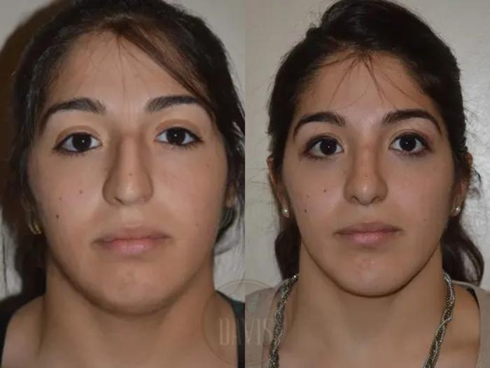 Before & After Chin Augmentation Case 1141 View 2 View in Tampa, FL