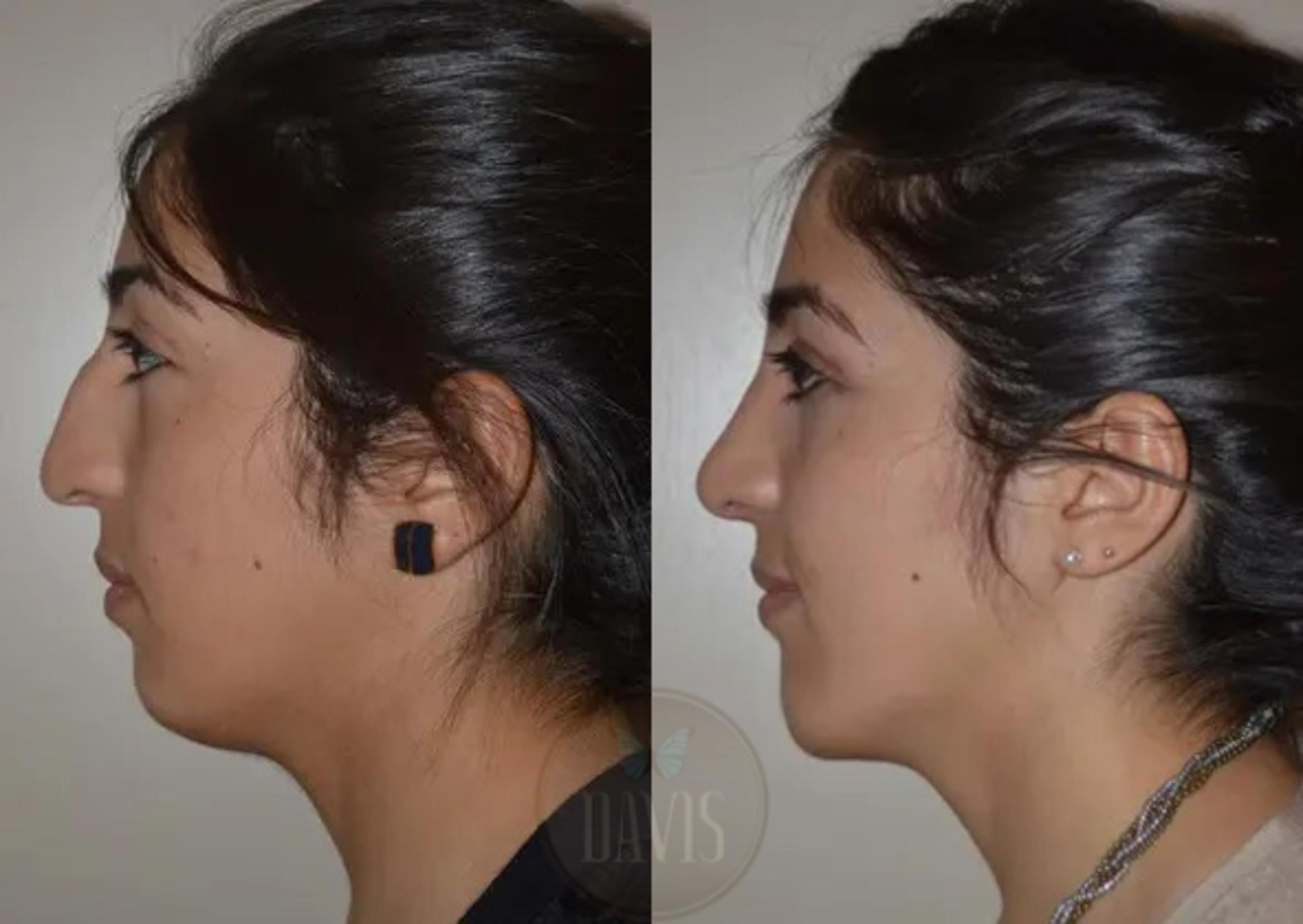 Before & After Chin Augmentation Case 1141 View 3 View in Tampa, FL