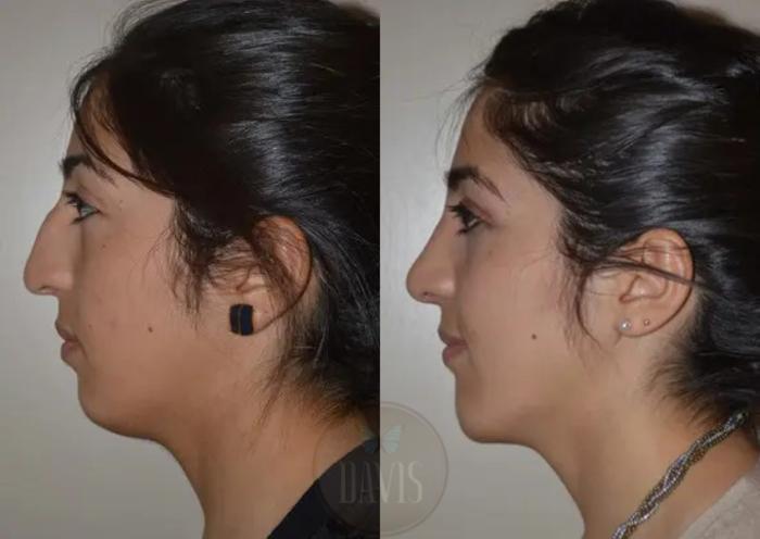 Before & After Chin Augmentation Case 1141 View 3 View in Tampa, FL