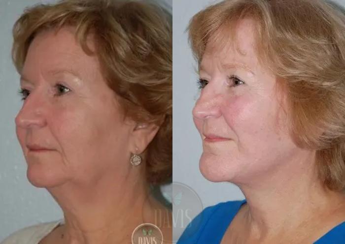 Before & After Chin Augmentation Case 1142 View 1 View in Tampa, FL