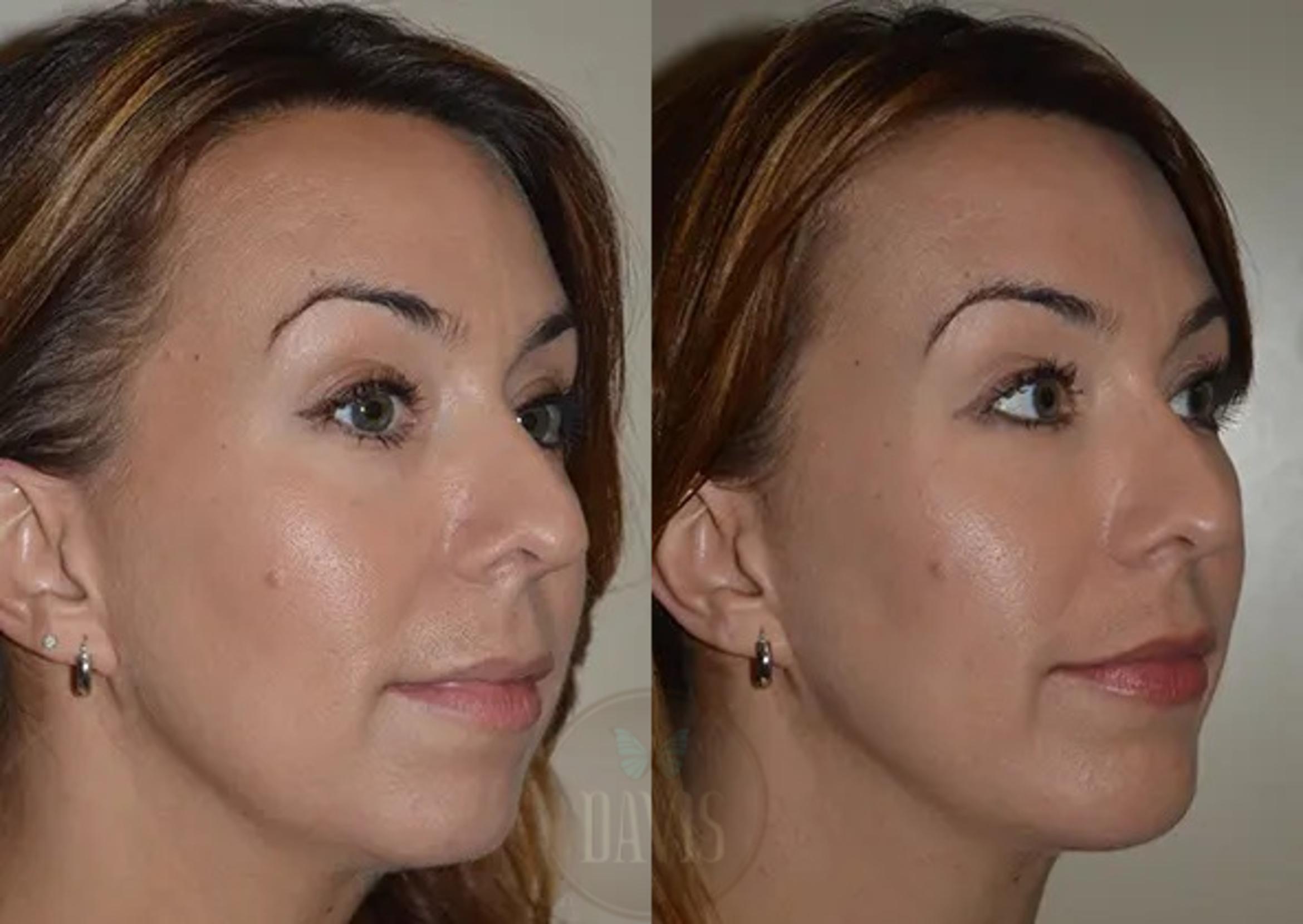 Before & After Chin Augmentation Case 1143 View 1 View in Tampa, FL