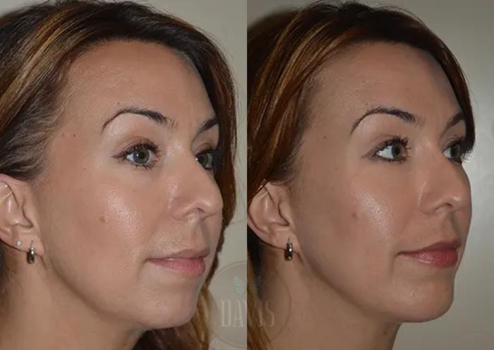 Before & After Chin Augmentation Case 1143 View 1 View in Tampa, FL