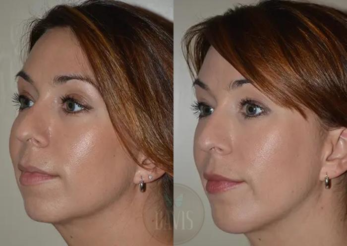 Before & After Chin Augmentation Case 1143 View 2 View in Tampa, FL