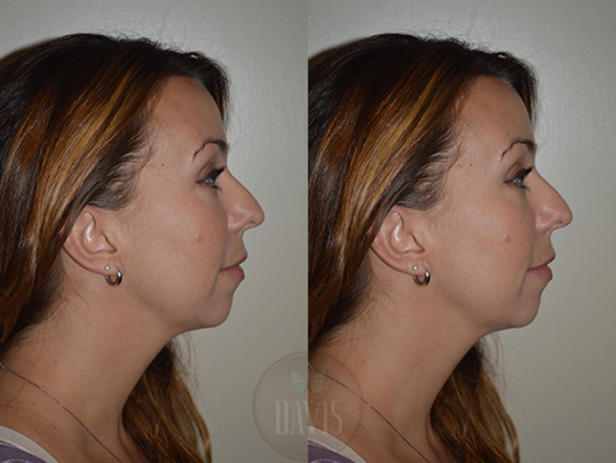 Before & After Chin Augmentation Case 1143 View 3 View in Tampa, FL