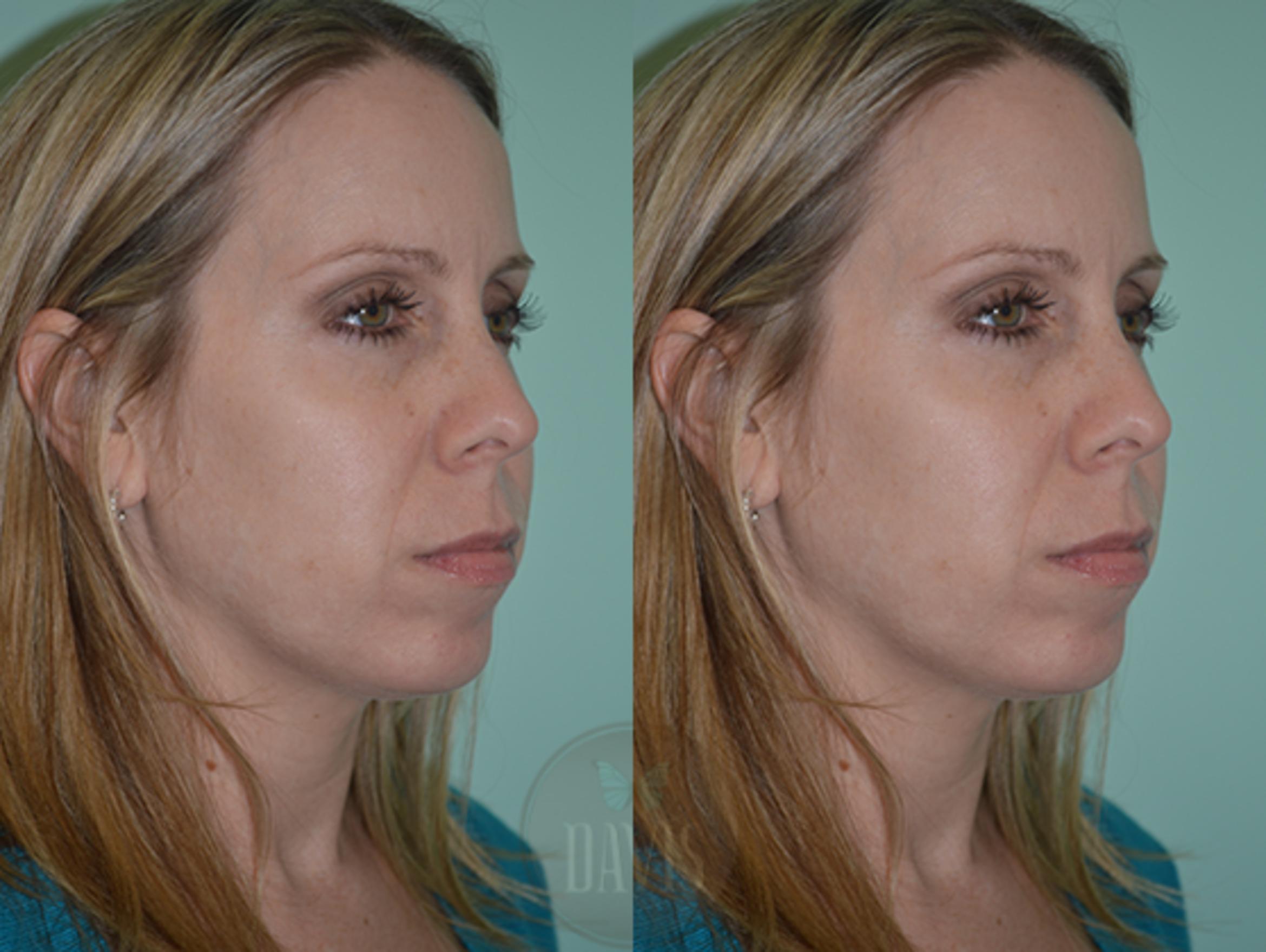 Before & After Chin Augmentation Case 1144 View 1 View in Tampa, FL