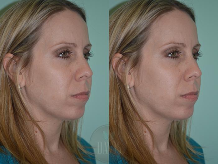 Before & After Chin Augmentation Case 1144 View 1 View in Tampa, FL