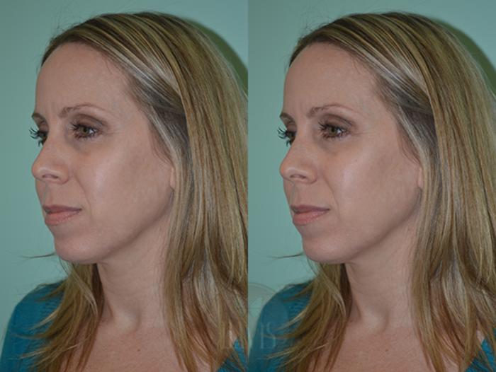 Before & After Chin Augmentation Case 1144 View 2 View in Tampa, FL