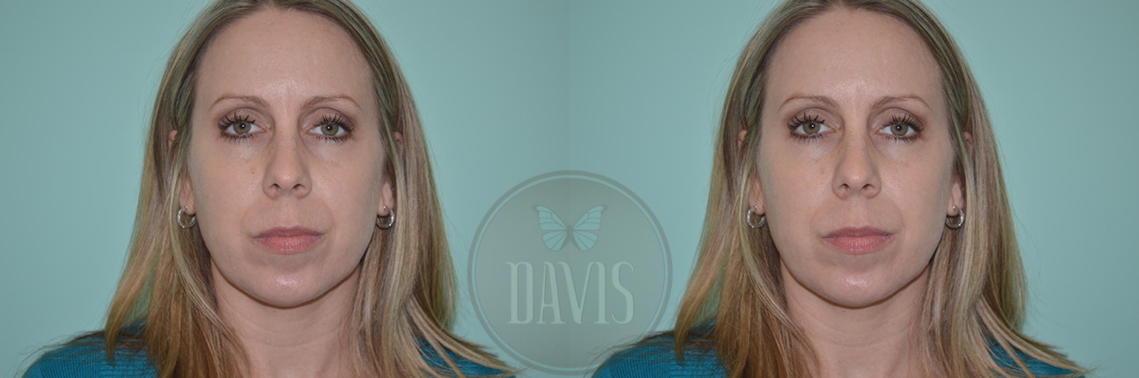 Before & After Chin Augmentation Case 1144 View 3 View in Tampa, FL