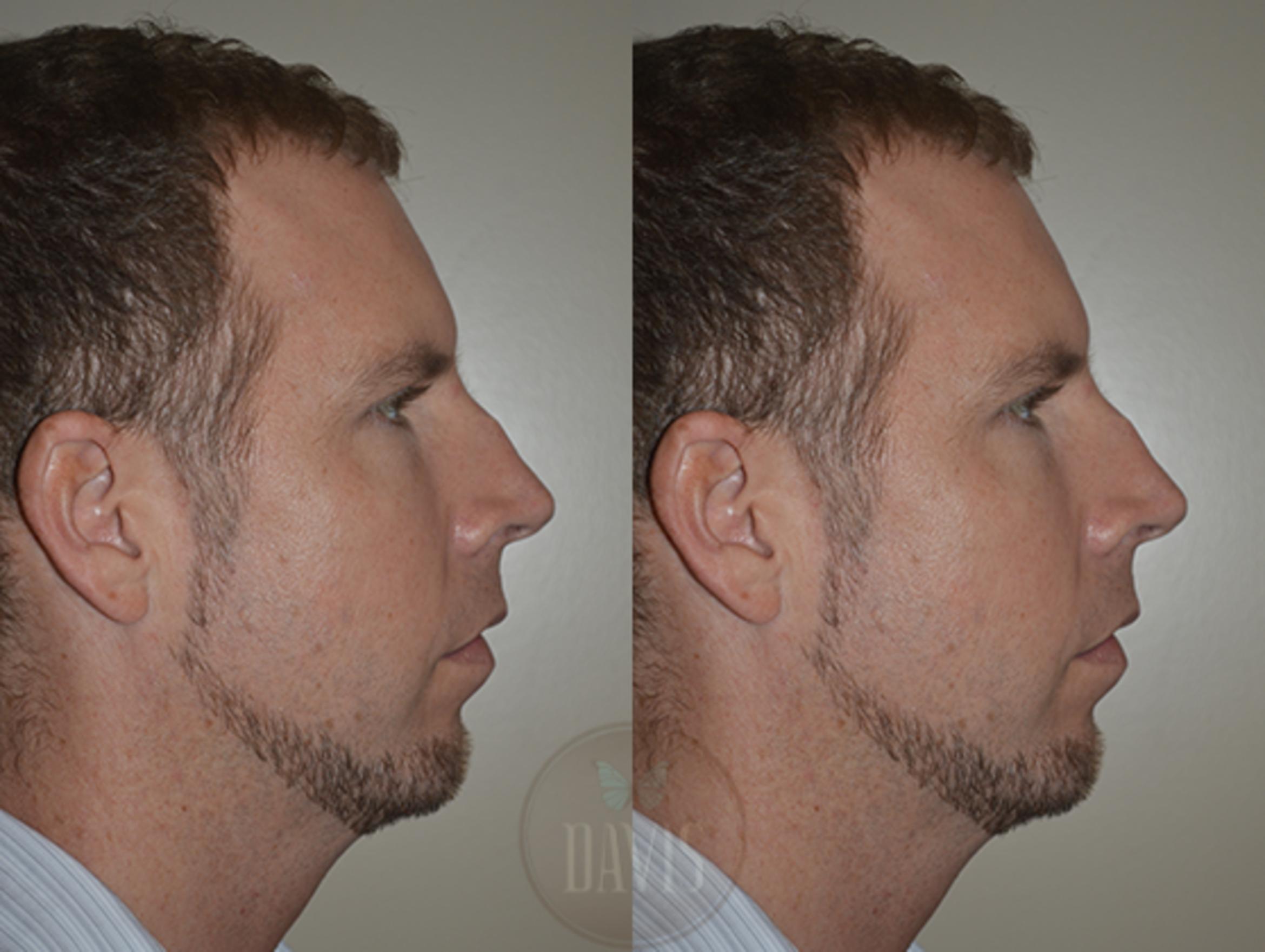 Before & After Chin Augmentation Case 1145 View 1 View in Tampa, FL