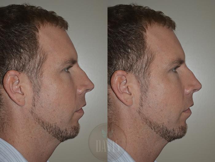 Before & After Chin Augmentation Case 1145 View 1 View in Tampa, FL