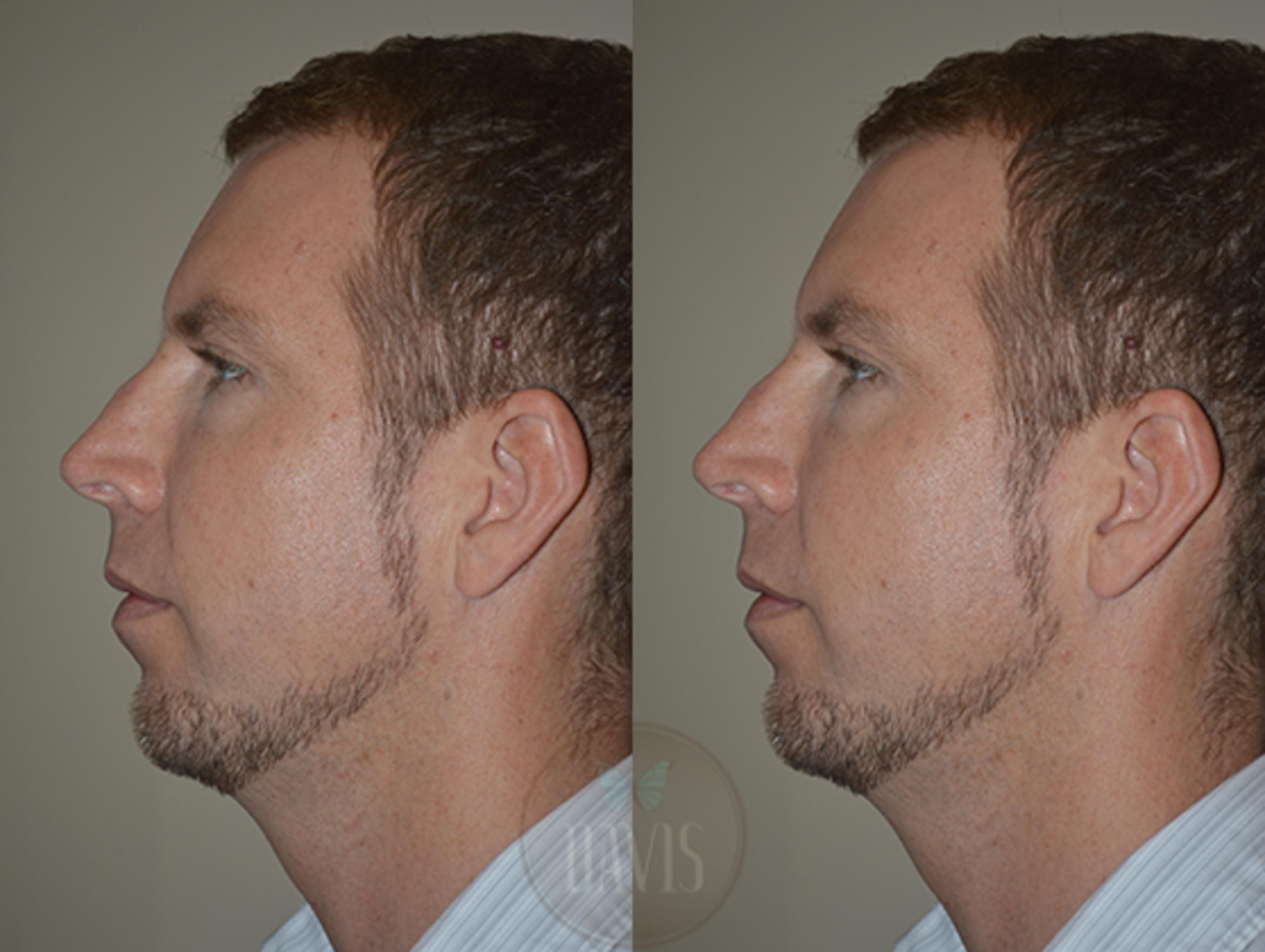 Before & After Chin Augmentation Case 1145 View 2 View in Tampa, FL