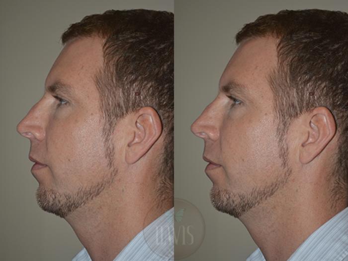 Before & After Chin Augmentation Case 1145 View 2 View in Tampa, FL