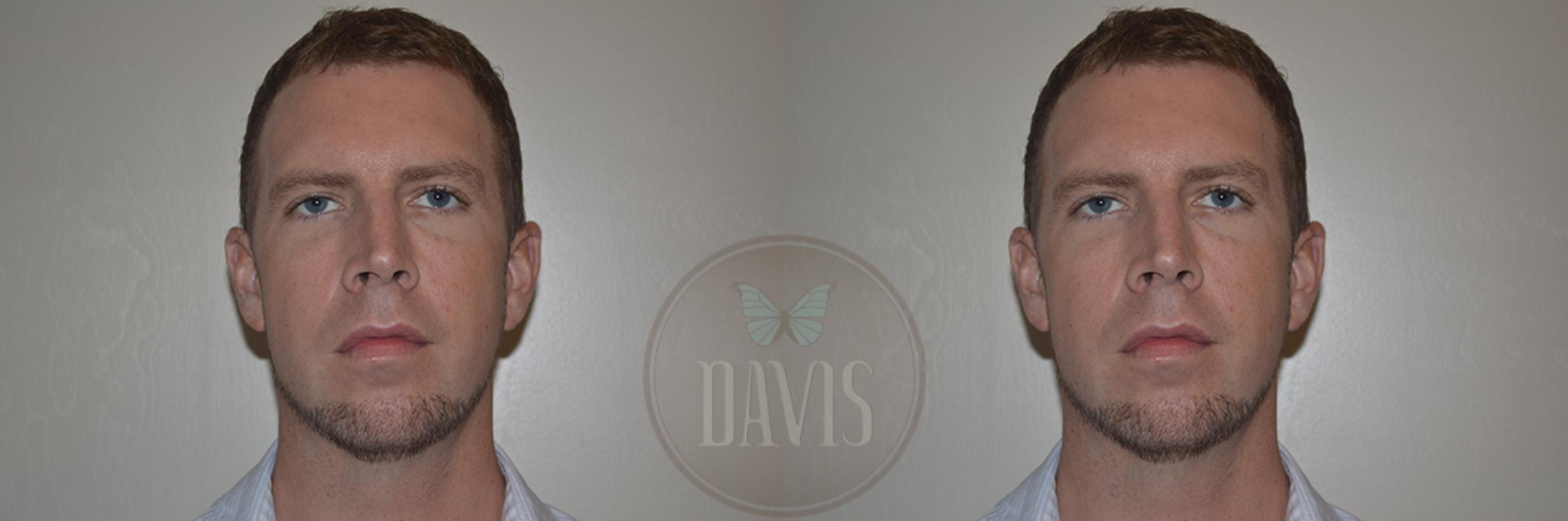 Before & After Chin Augmentation Case 1145 View 3 View in Tampa, FL