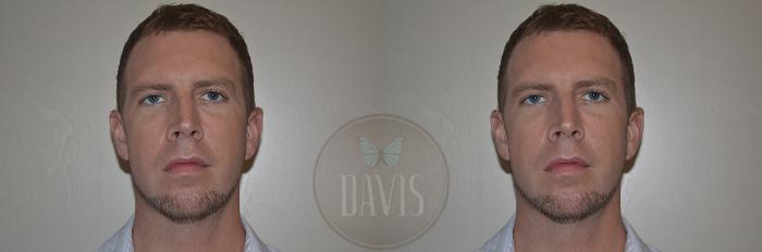 Before & After Chin Augmentation Case 1145 View 3 View in Tampa, FL