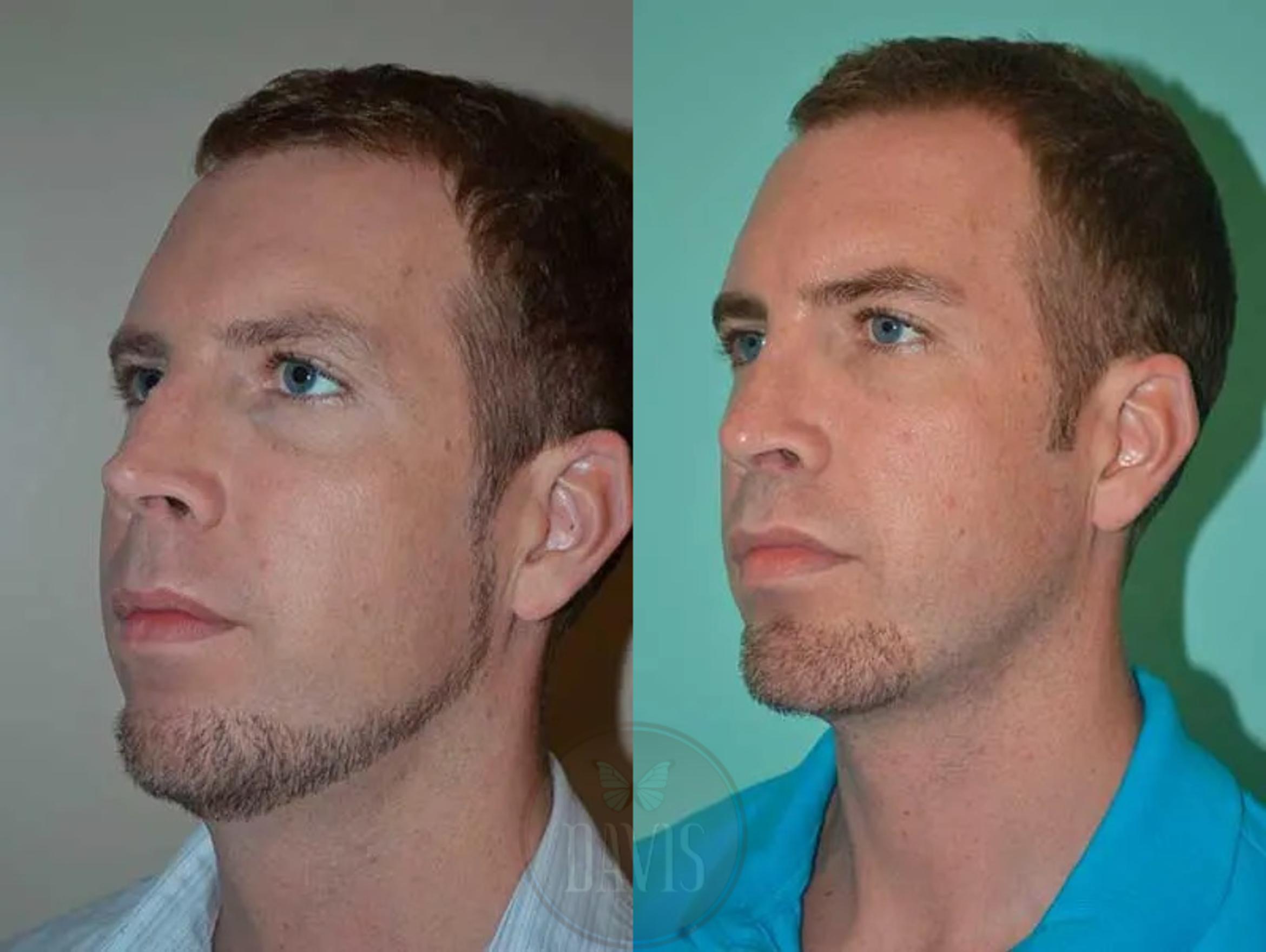 Before & After Chin Augmentation Case 1145 View 5 View in Tampa, FL