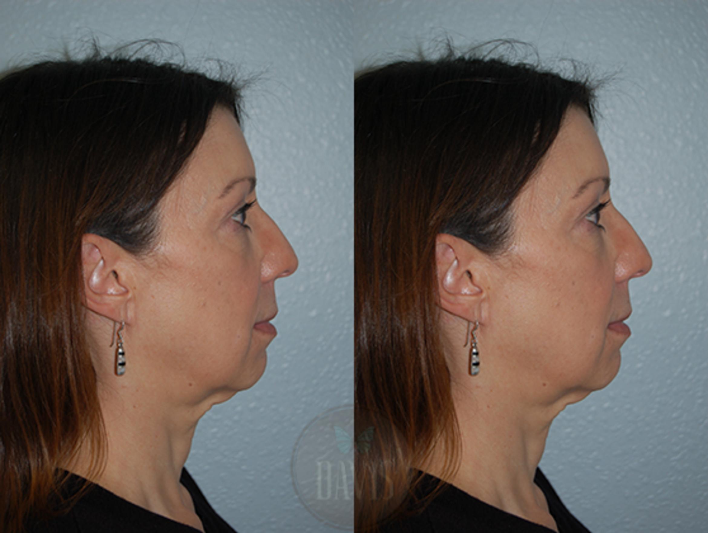 Before & After Chin Augmentation Case 1146 View 1 View in Tampa, FL