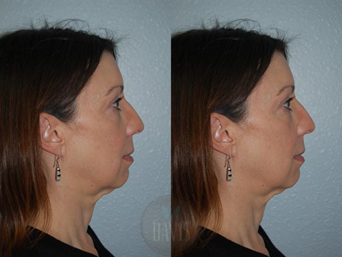 Before & After Chin Augmentation Case 1146 View 1 View in Tampa, FL
